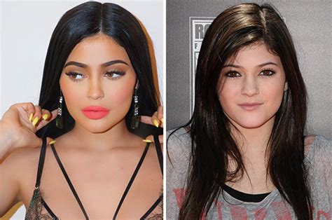 kylie jenner before|kylie jenner plastic surgery transformation.